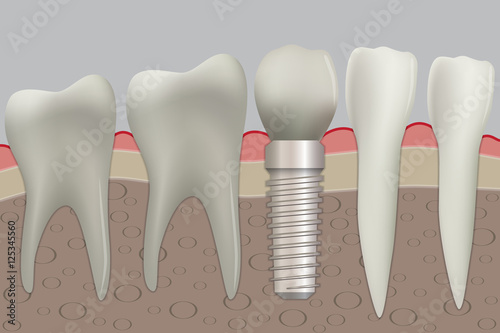 Normal teeth and dental implant. Vector illustration.