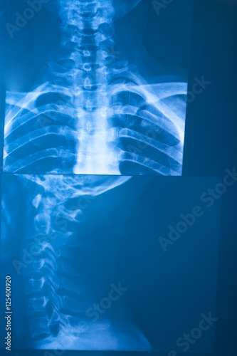 X-Ray Radiography

X-Ray film of back and side of the neck.
