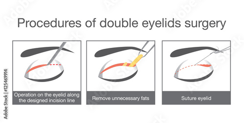 Procedures of double eyelids surgery. Illustration about cosmetic surgery. 