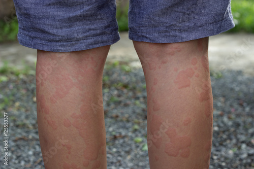 skin allergies, legs skin women.