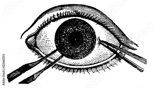 Iridectomy, vintage engraving