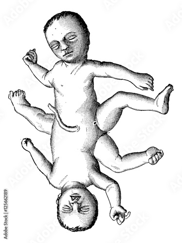 Ischiopagi or Conjoined Twins united at the Pelvis, vintage engr