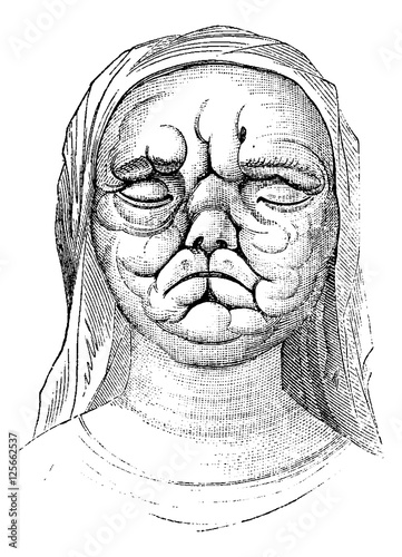 Leprosy or Hansen's Disease, vintage engraving photo