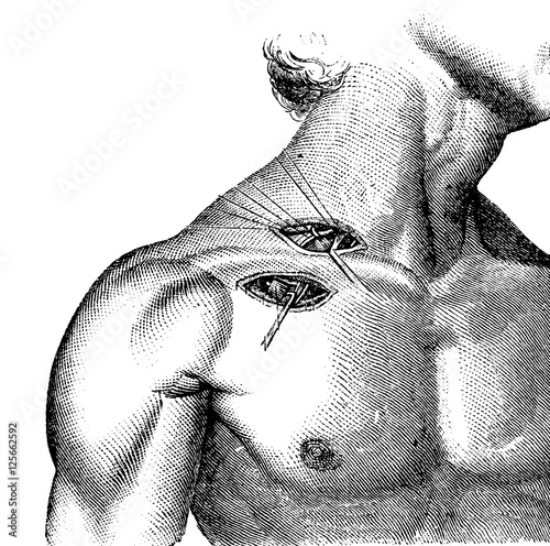 Ligation of the artery and axillary subclavian, vintage engravin