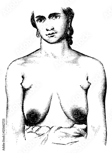 Extra teats placed in each axilla of breast, vintage engraving