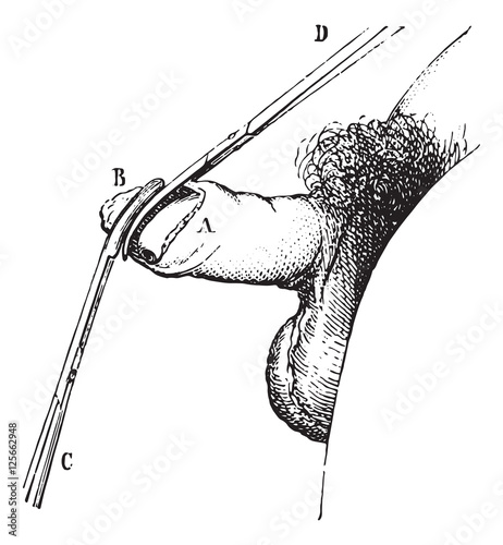 Operation of phimosis by circumcision, vintage engraving. photo