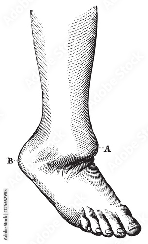 Dislocation of the foot back, vintage engraving.