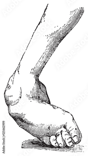 Clubfoot associated with equine varus, vintage engraving.