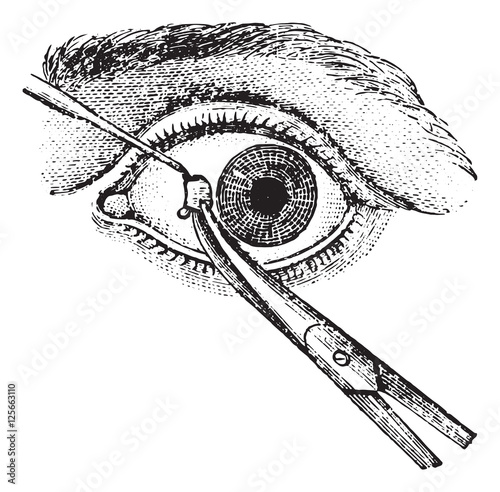 Strabismus surgery, vintage engraving.