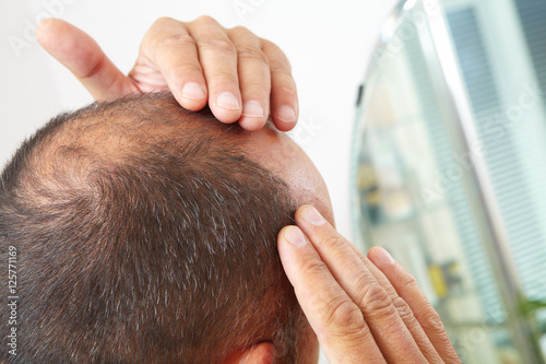 Senior man and hair loss issue