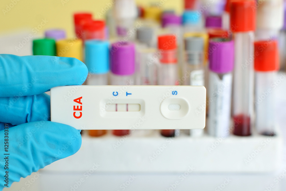 Rapid test cassette for CEA test (intestinal cancer diagnosis) , the result showed positive Rapid test cassette for CEA test (intestinal cancer diagnosis) , the result showed positive