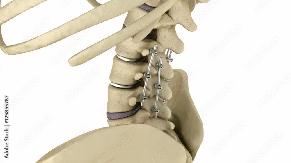 Spinal Fixation System Titanium Bracket Medically Accurate Tooth 3d 