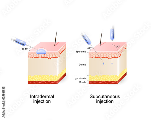 Intradermal and Subcutaneous injection. Angle and depth of injections photo
