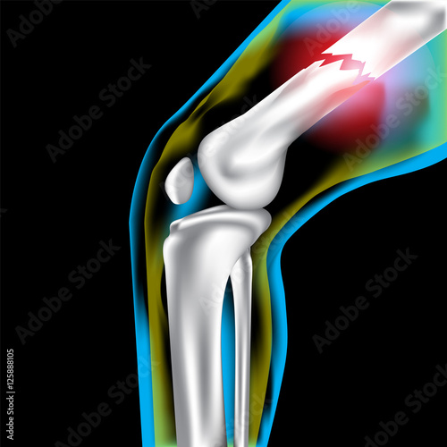 Bone knee broken