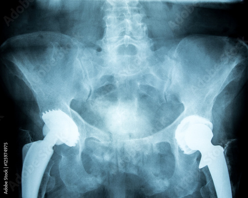 Zwei künstliche Hüftgelenke nach Operation Röntgen Bild Aufnahme