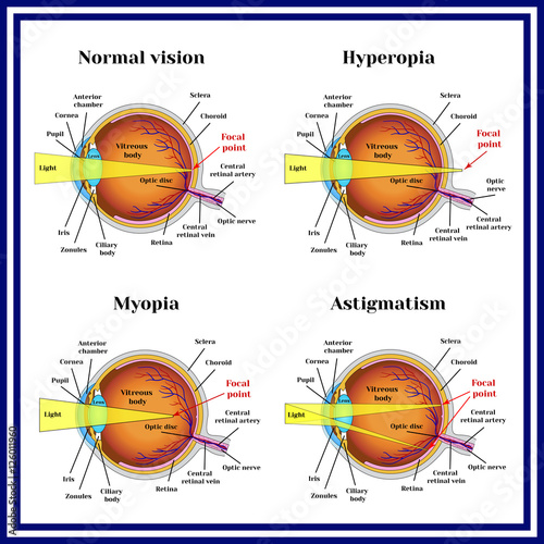 Refractive errors eyeball: hyperopia, myopia, astigmatism.