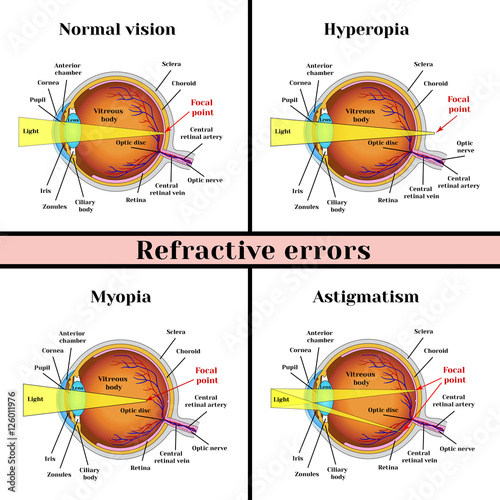 Refractive errors eyeball: hyperopia, myopia, astigmatism.