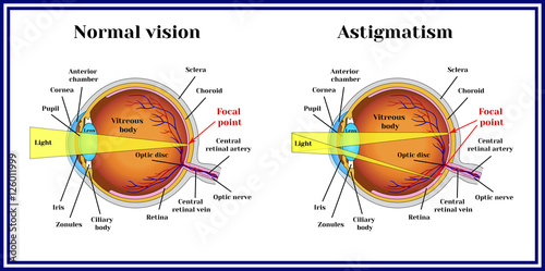Refractive errors eyeball. Astigmatism. photo