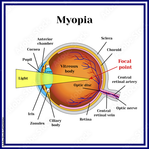 Refractive errors eyeball. Myopia. photo