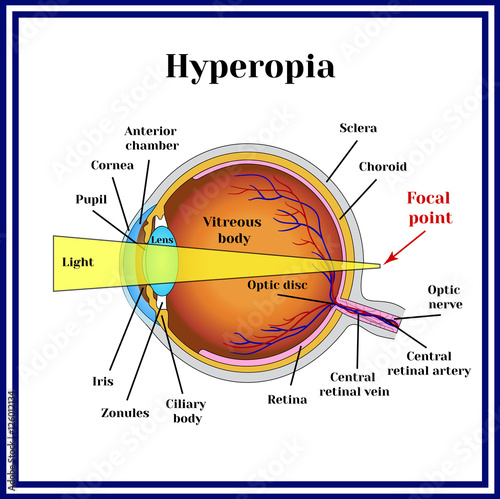 Refractive errors eyeball. Hyperopia.