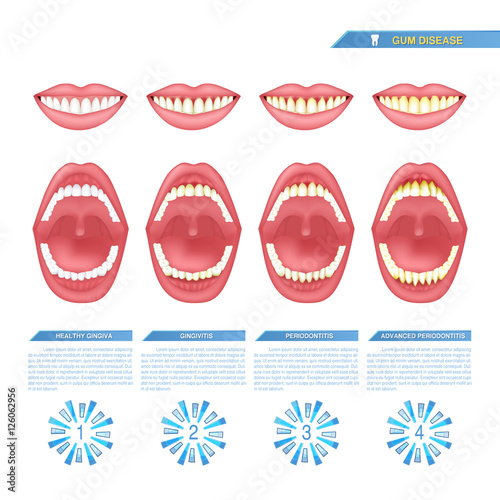 the progress of periodontal disease, gum disease..