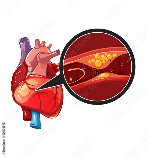 Myocardial infarction vector photo