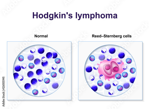 Hodgkin's lymphoma