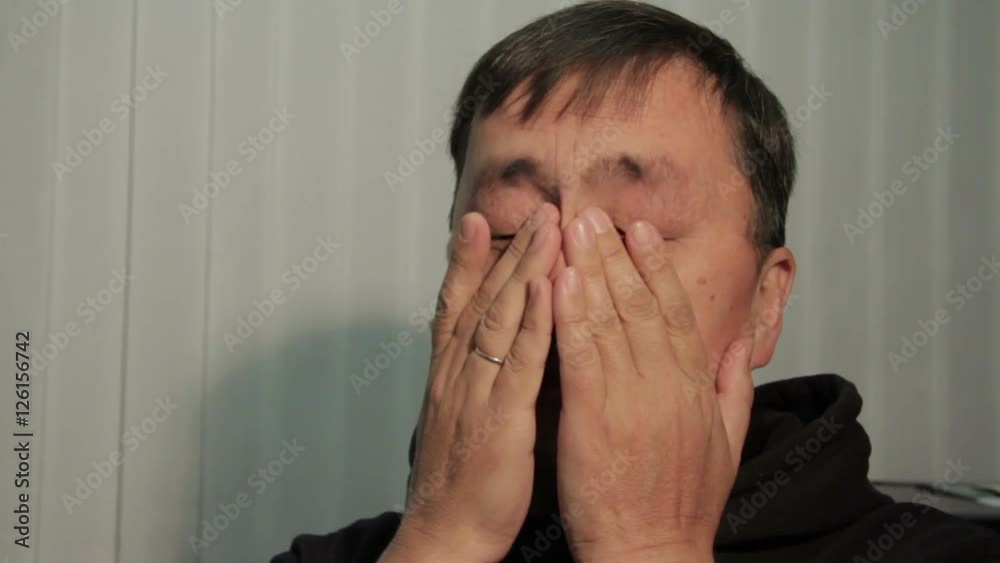 Asian man with diseases eyes looking at the camera. Asian man with diseases eyes looking at the camera.