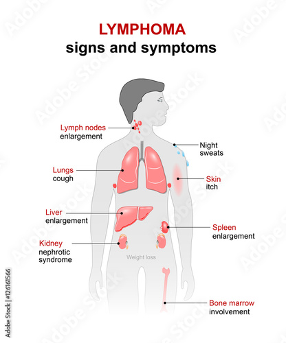 lymphoma. Signs and symptoms