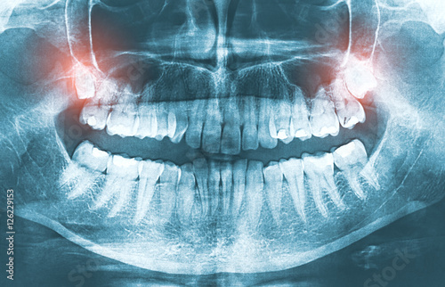 Closeup of x-ray image growing wisdom teeth pain concept.