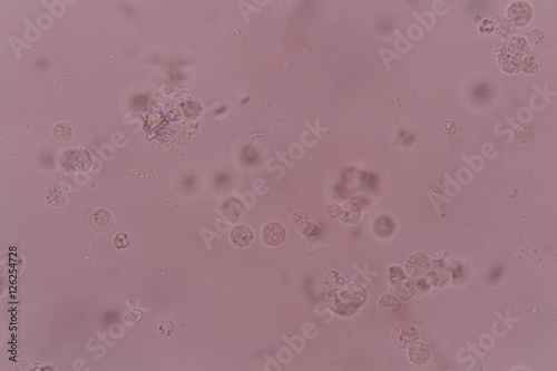 white blood cell clumping in urine