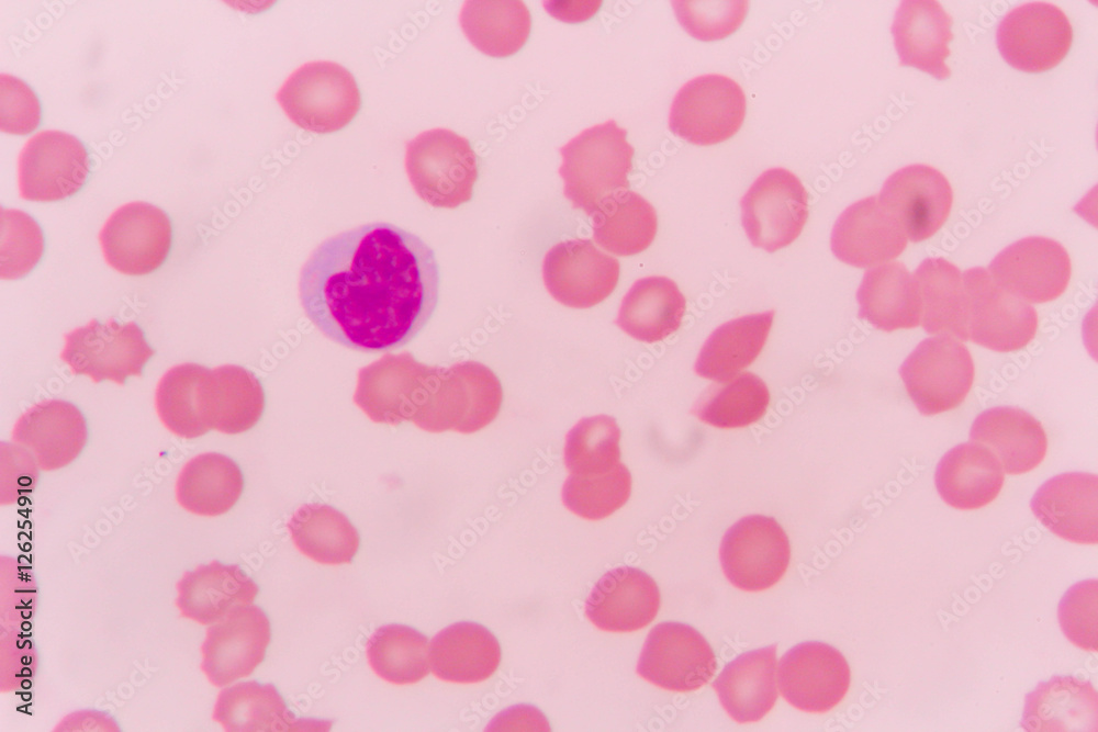 Lymphocyte  human blood cell under microscope,complete blood count.