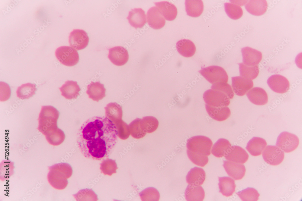 Neutrophil human blood cell under microscope,complete blood count.