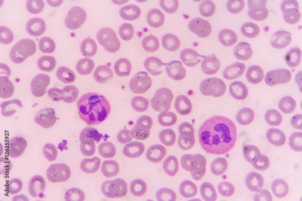 slide blood smear show neutrophil for complete blood count slide blood smear show neutrophil for complete blood count
