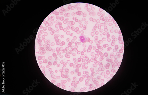 in Slide blood smear show target cell for complete blood count in microscope