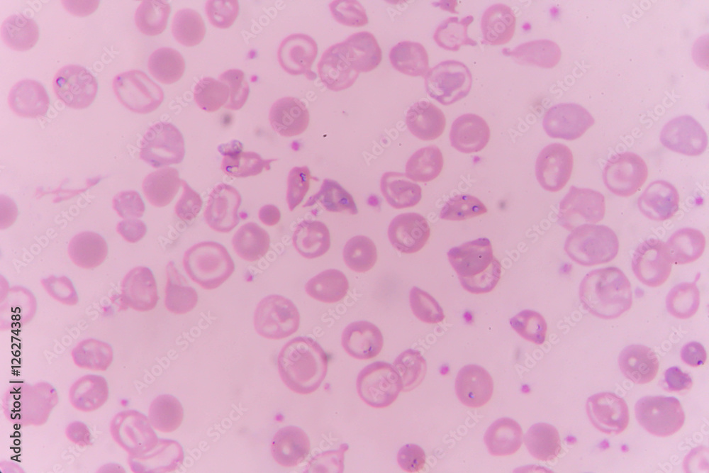 in slide blood smear show Nucleated red cell for complete blood count