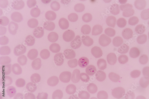 plasmodium falciparum infections red blood cells
