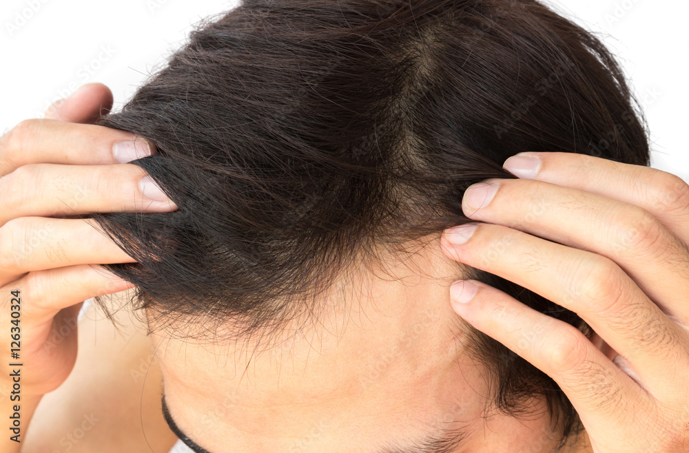 Fototapeta premium Young man serious hair loss problem for hair loss concept