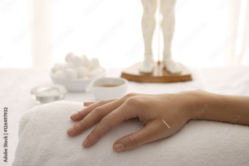acupuncture needle in woman's hand