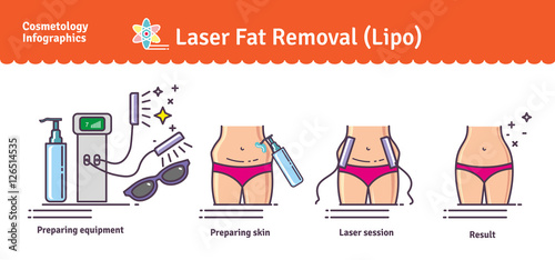 Vector Illustrated set with Laser LIPO Fat Removal
