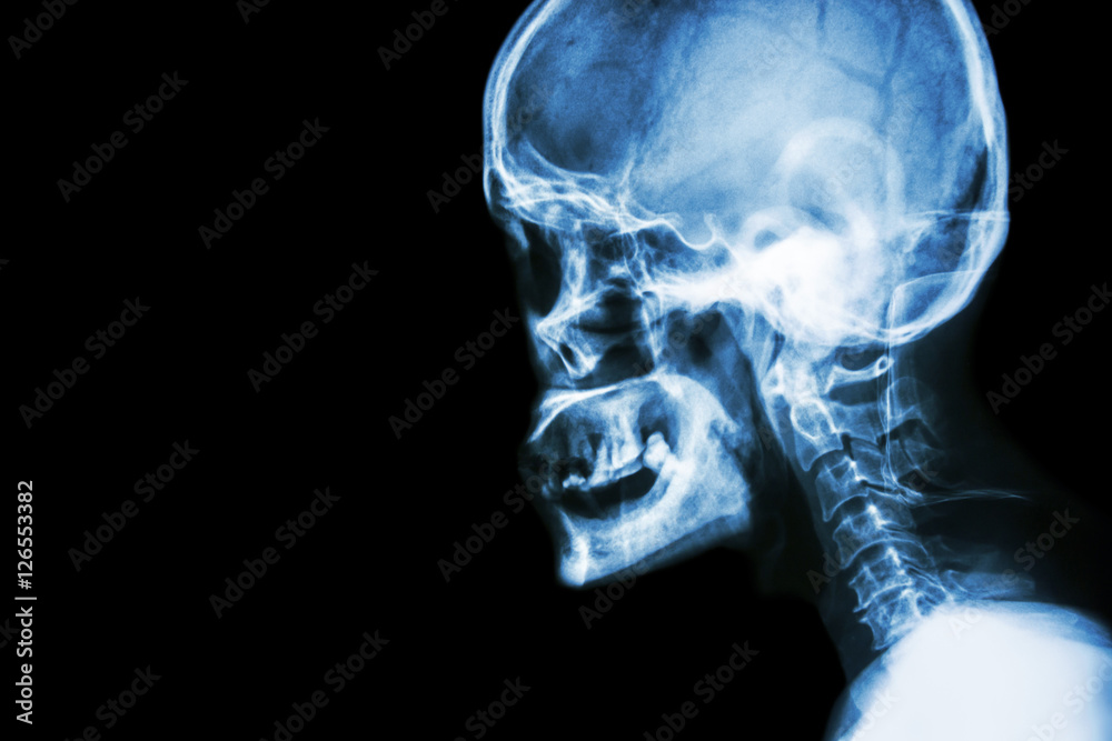 Film x-ray Skull lateral view show normal human's skull and cervical spine and blank area at left side Film x-ray Skull lateral view show normal human's skull and cervical spine and blank area at left side