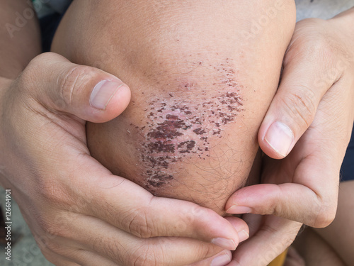 wound scab on the human skin photo