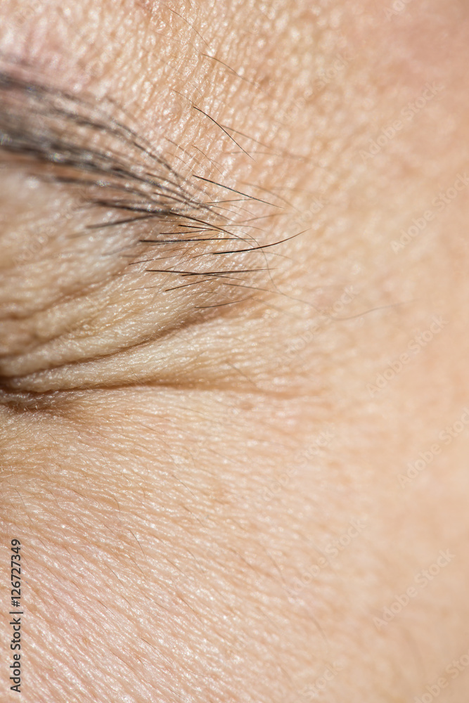 Wrinkles under the eyes Wrinkles under the eyes