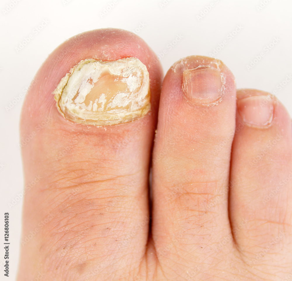 fungal nail infection fungal nail infection