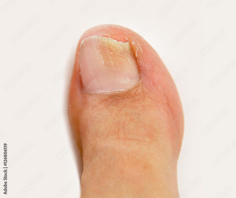 fungal nail infection fungal nail infection