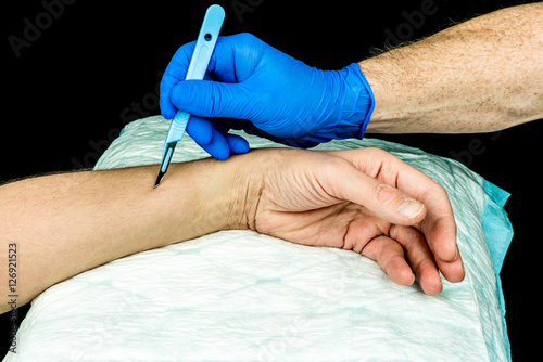 Hand with blue medical glove holding a scalpel to make an incision on an arm. Close up with black background. 