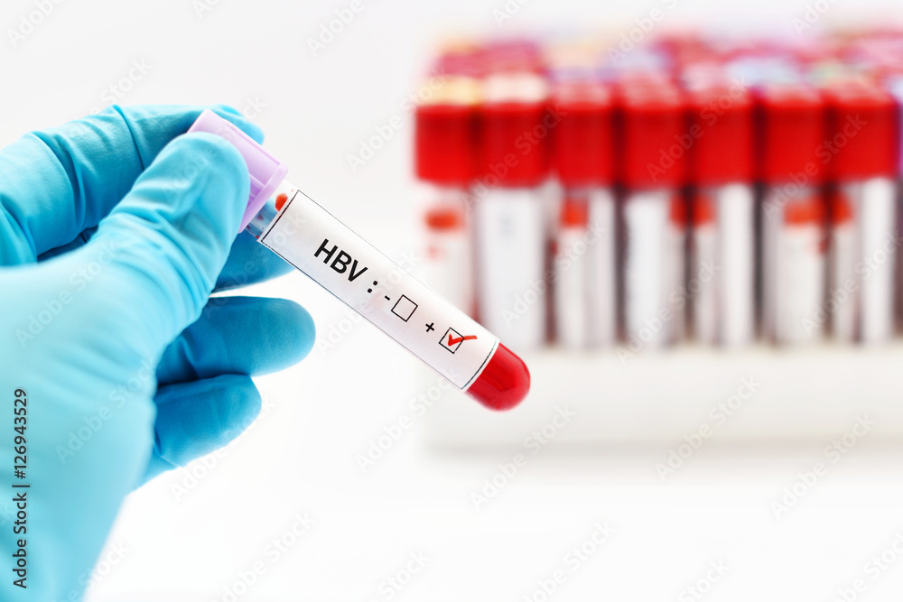 Fototapeta premium Blood sample with hepatitis B virus (HBV) positive