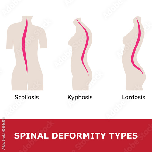 scoliosis, lordosis and kyphosis. vector illustration of spinal deformity types. photo