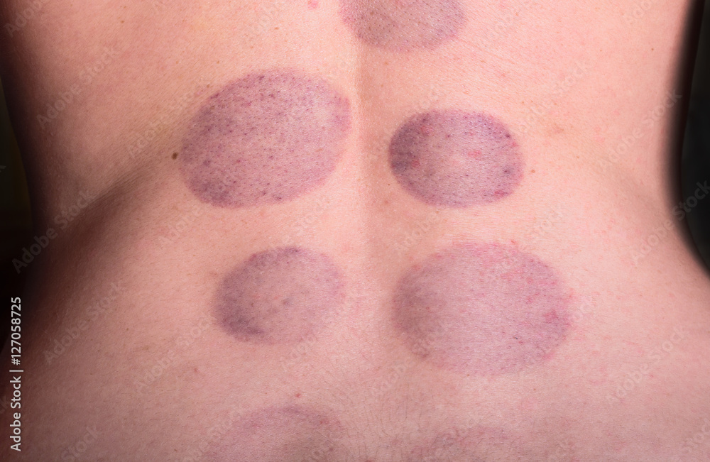 Fototapeta premium Cupping therapy on hirudo medicinalis human body