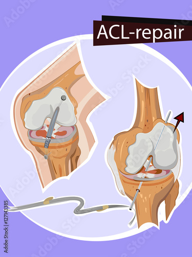 Vector illustration of Knee repair photo